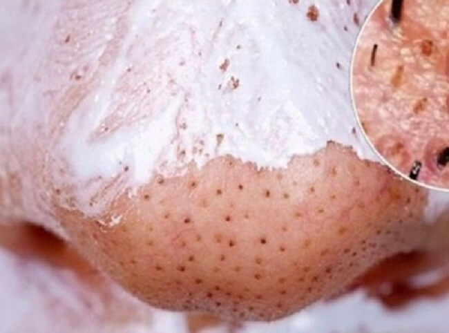 Bật mí 5 cách trị mụn đầu đen, mụn sưng hiệu quả mà dễ thực hiện Bật mí 5 cách trị mụn đầu đen, mụn sưng hiệu quả mà dễ thực hiện